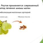 В ЦГКБ г. Реутов применяется современный метод лечения миомы матки